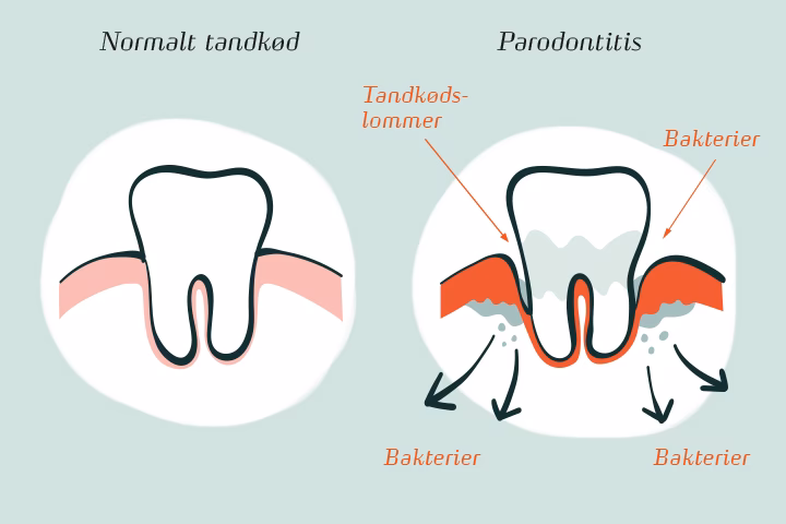 Hvorfor har jeg ondt i tænderne, når jeg spiser sukker?